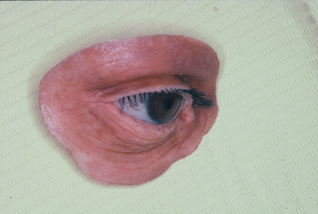 athens ocular prostheseis 3