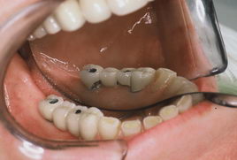 dental bonding 5 right