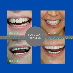 porcelain veneers, ceramic veneers before and after